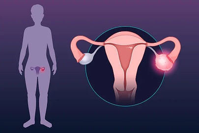 Tubal factor of infertility